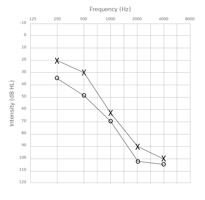 Audiogram Allxallolines