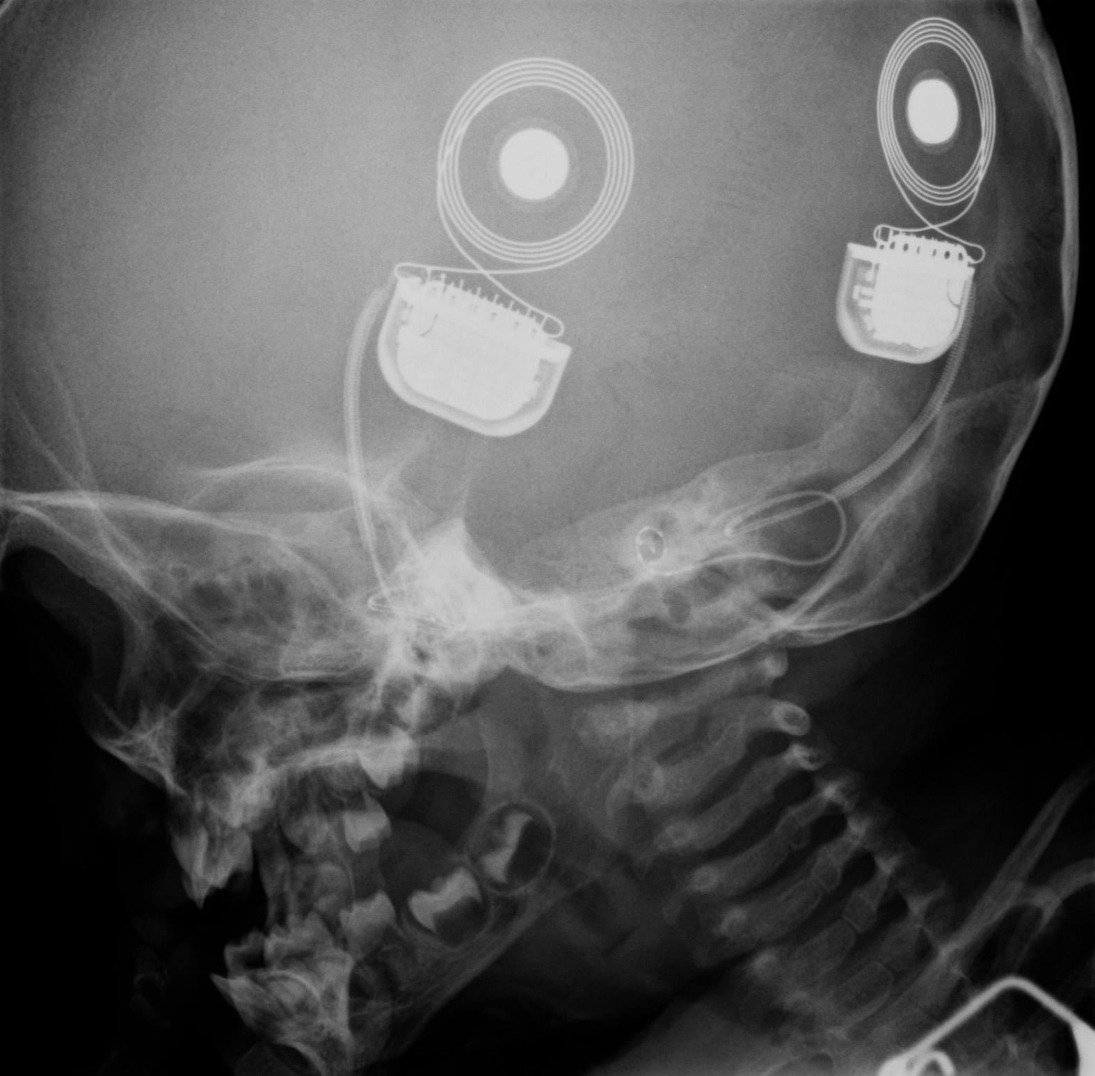 Raio-X da cóclea com o implante coclear