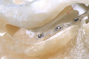 A MED-EL electrode fits into the scala tympani.