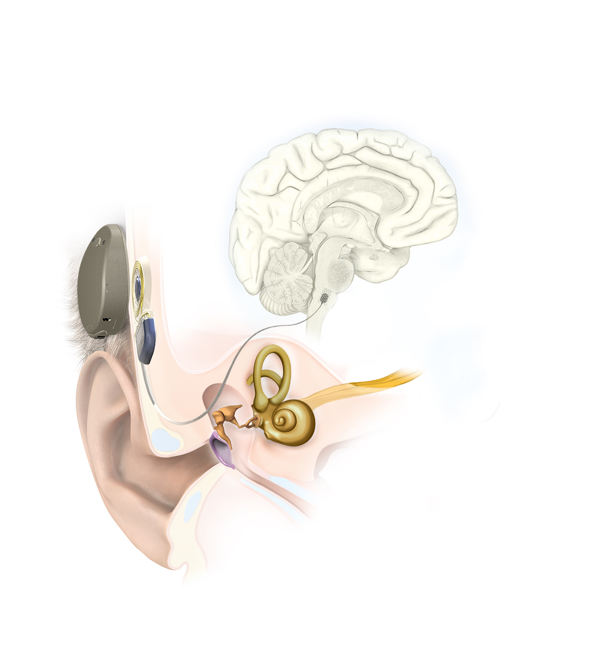 Auditory Brainstem Implant Illustration