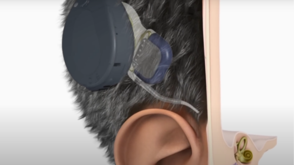 Rubies, Gold, and Platinum: What's Inside Your Cochlear Implant? - The ...