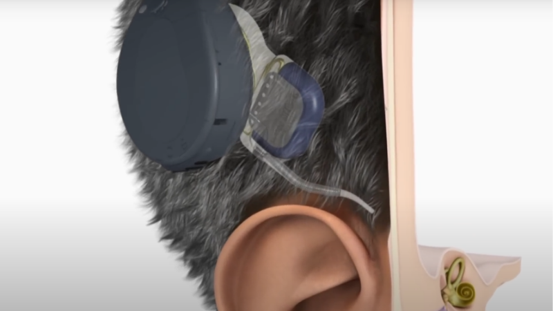 Blogpost Video Thumbnail - How does a cochlear implant work