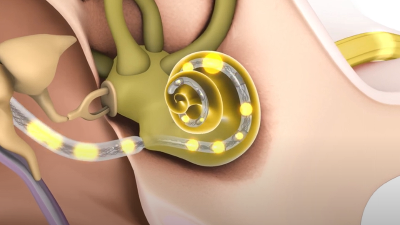 How Does A Cochlear Implant Work?