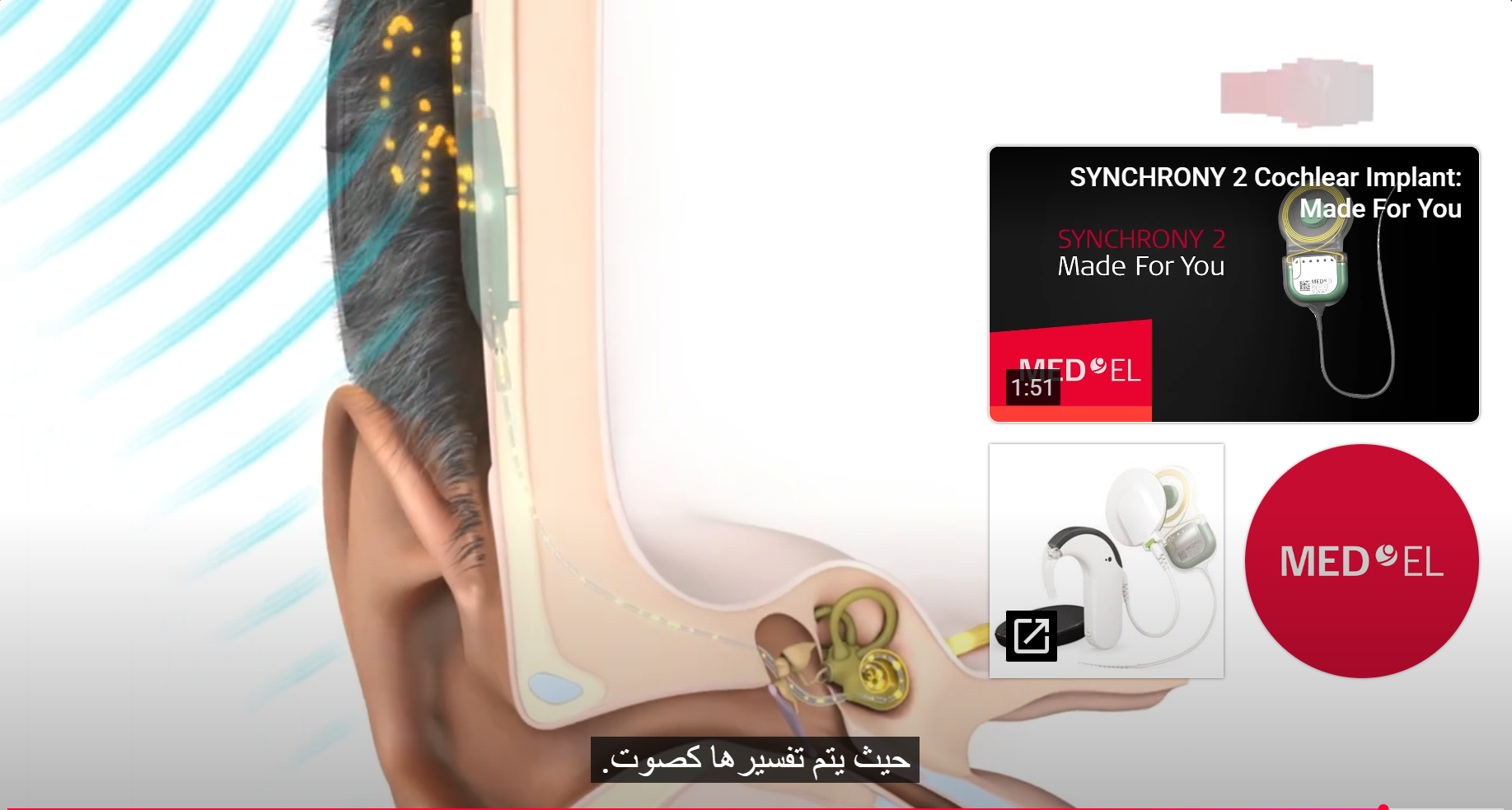 كيف تسمع باستخدام زرعة القوقعة؟