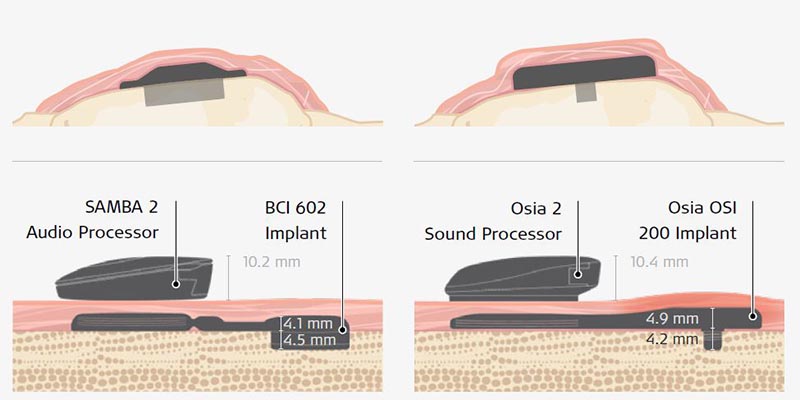 Bone conduction implants compared