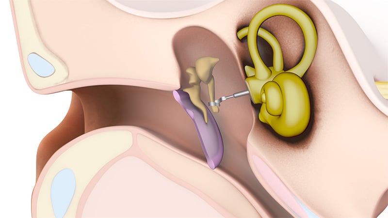 Passive middle ear implants: Stapes prostheses replace the stapes