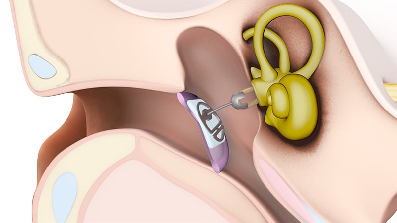Passive middle ear implants: Partial prostheses replace the malleus and incus