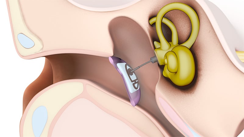 Passive middle ear implants: Total tympanoplasty prostheses replace the malleus, incus, and stapes