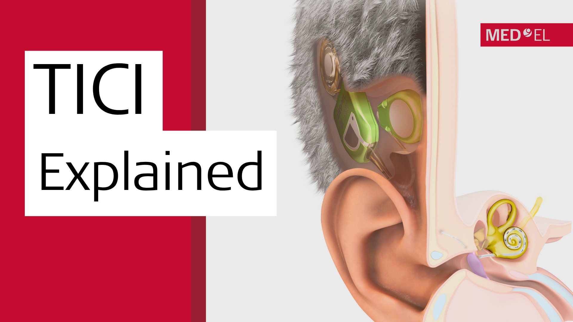 TICI shown with inner ear anatomy
