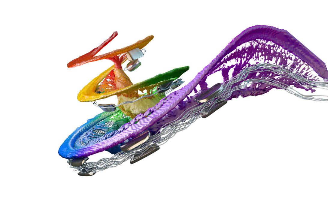 Long electrode array inserted into cochlea