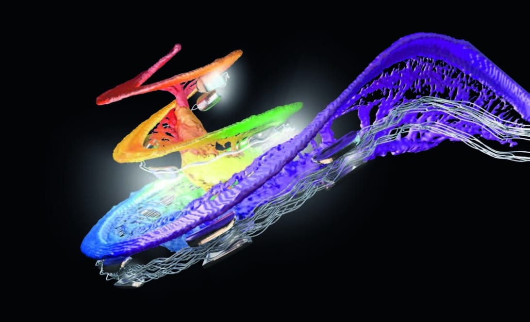Individuelle Elektrodenlänge für die Cochlea