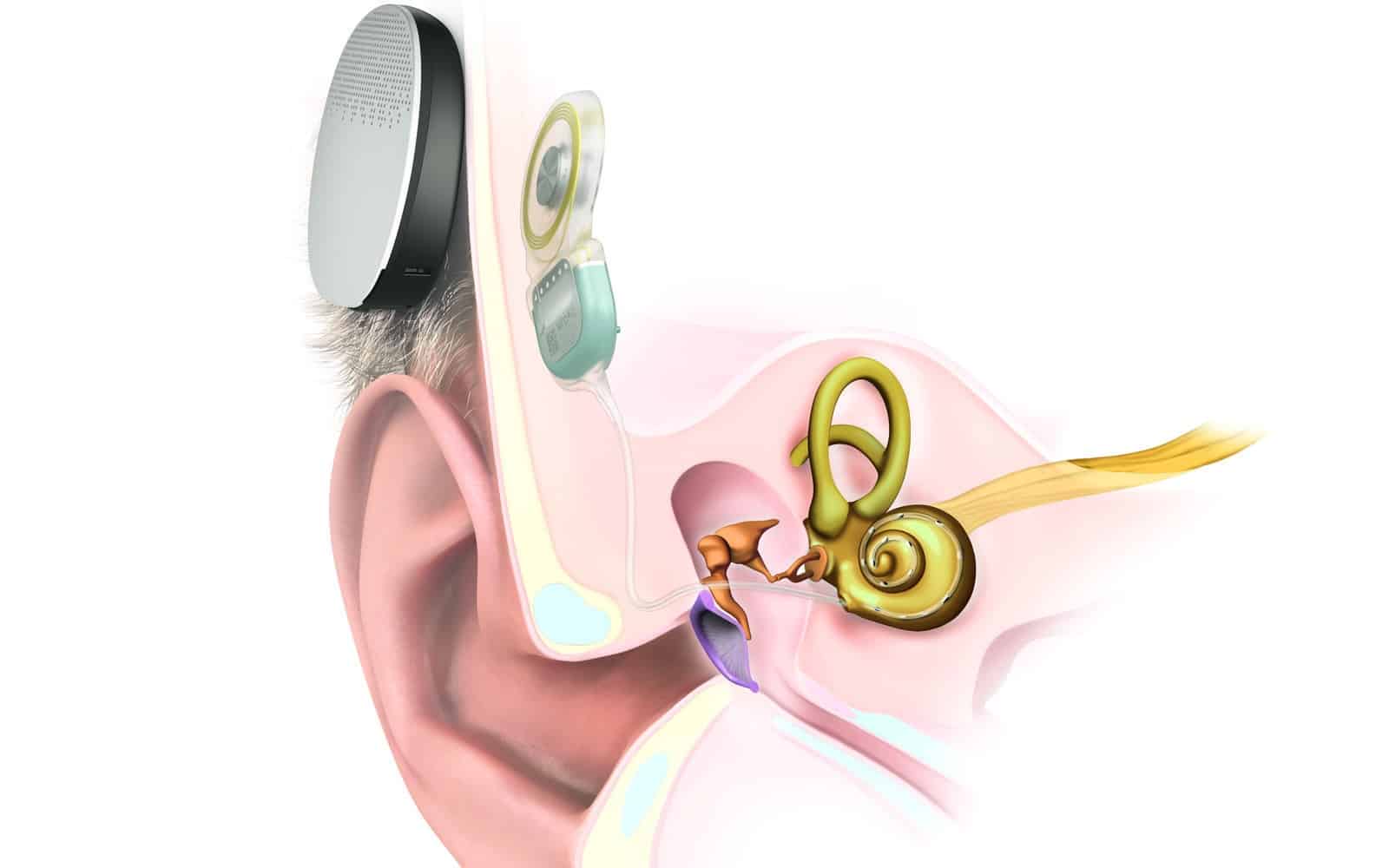 How a cochlear implant works