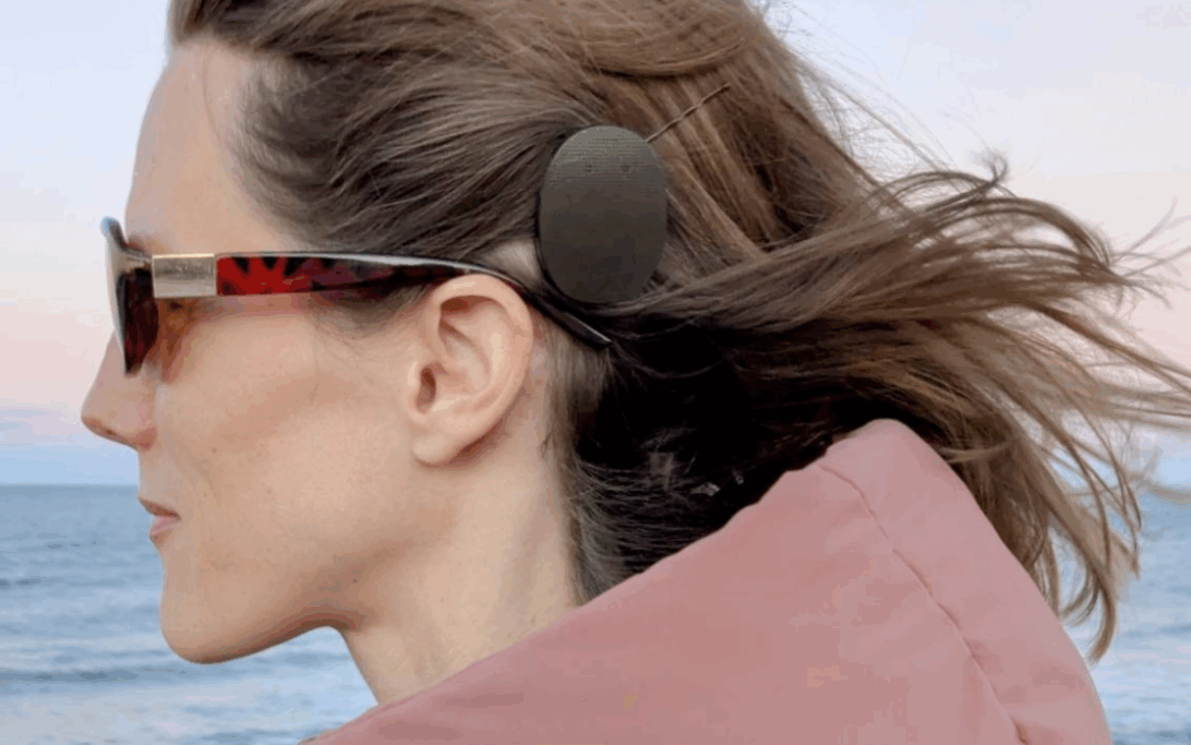 Carly wearing a cochlear implant on the beach after eight years of living with single-sided deafness.