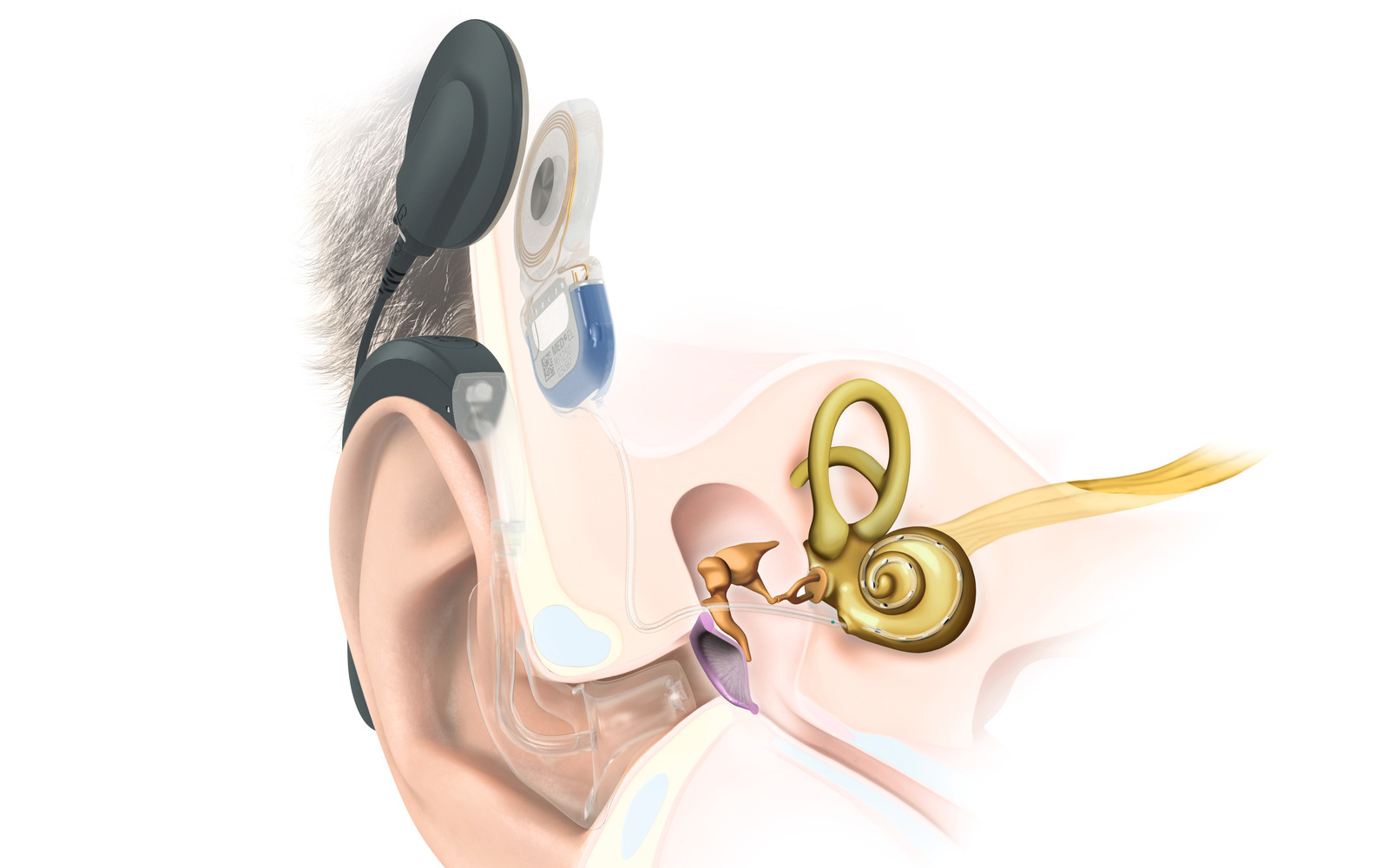 Sensorineural hearing loss explained