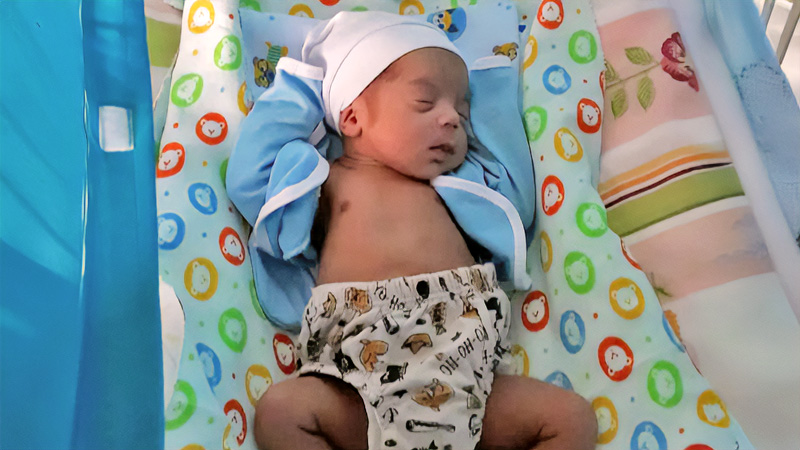 Davi recém-nascido com faixas na cabeça pós-cirurgia de implante coclear