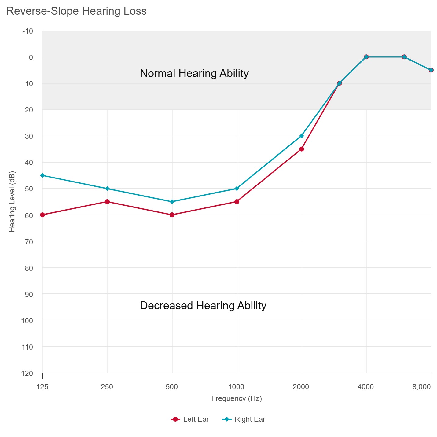 Reverse-Slope Hearing Loss Audiogram