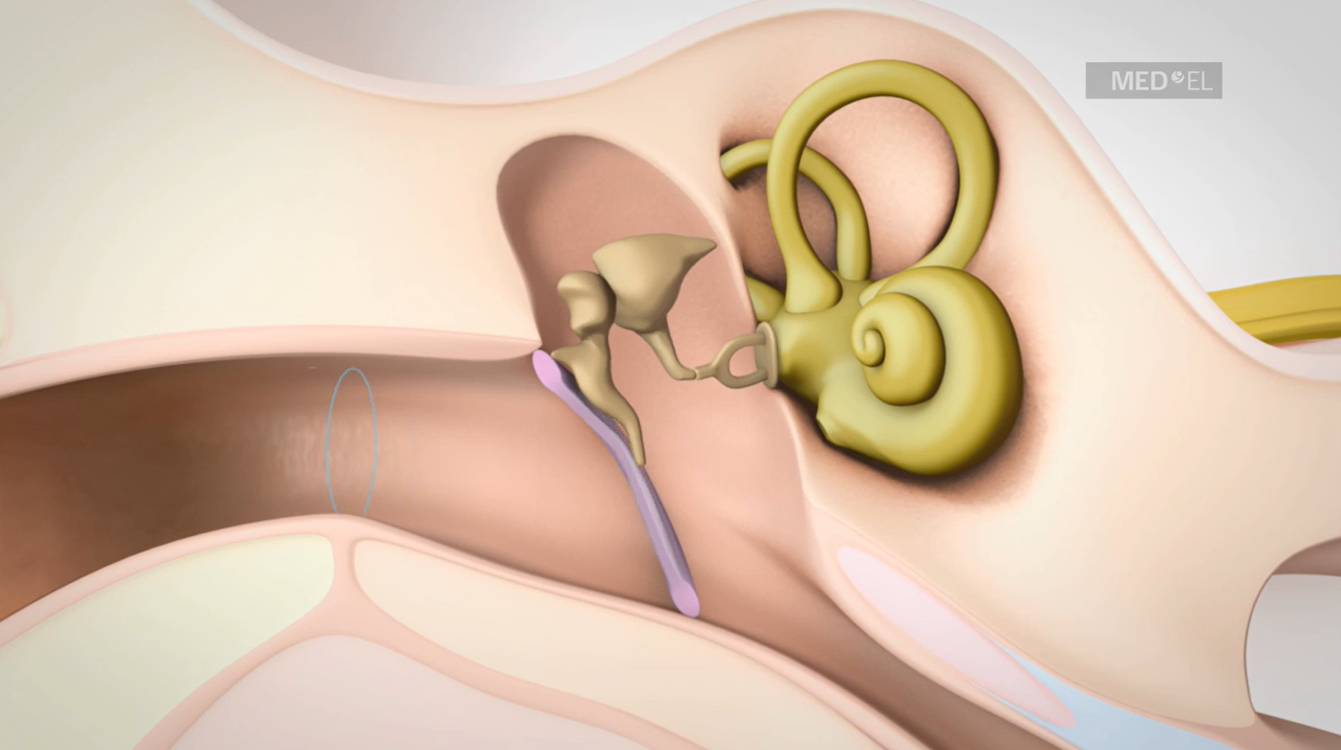 Conductive Hearing Loss Explained