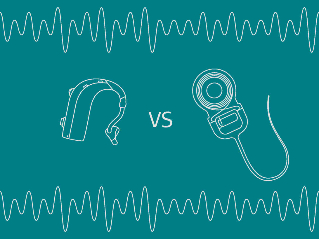 hearing aids vs cochlear implants