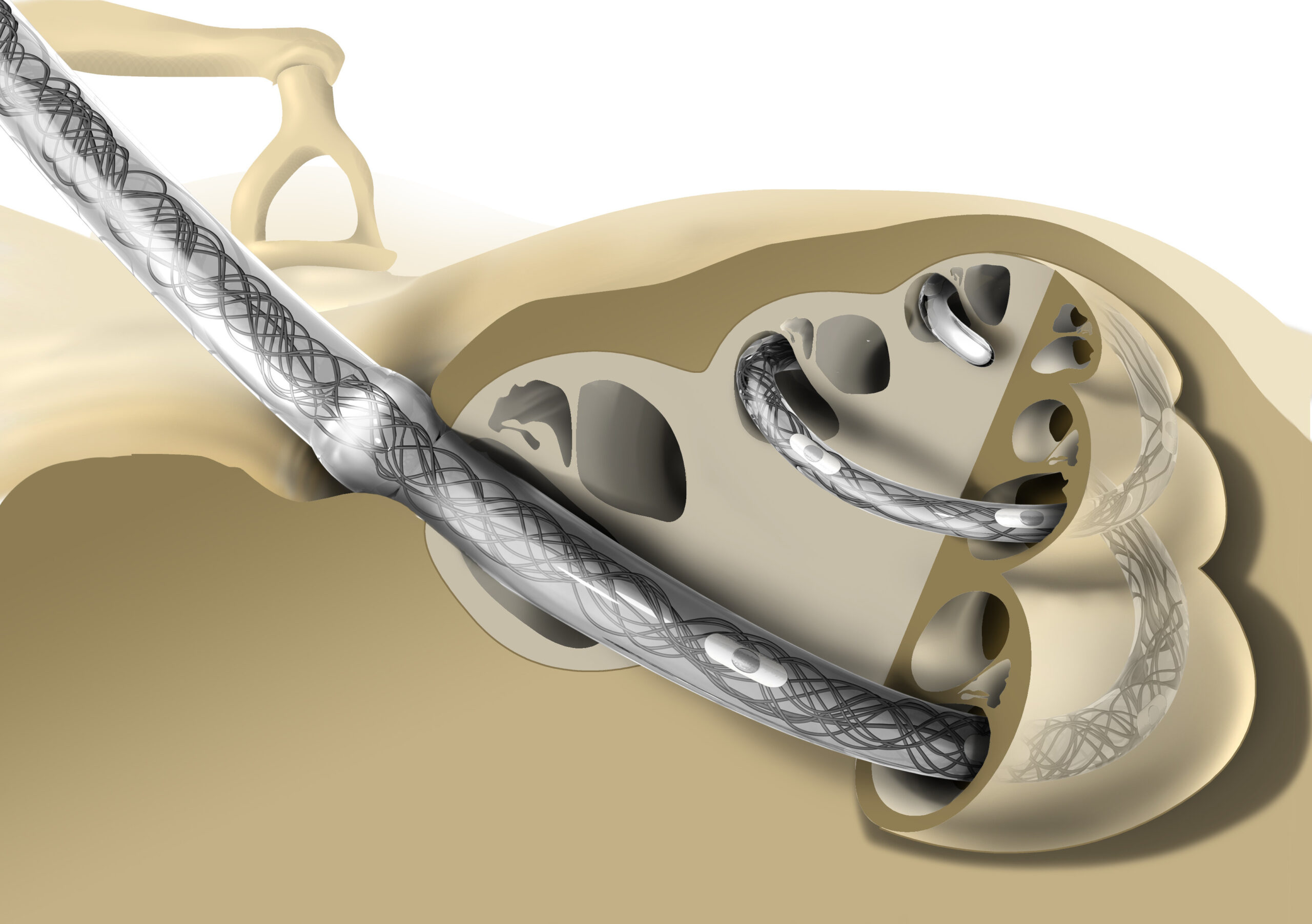 CI electrode in the cochlea